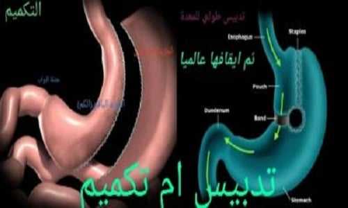 تدبيس ام تكميم